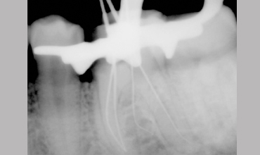 Veneerscrown and bridges treatment in Anand                        